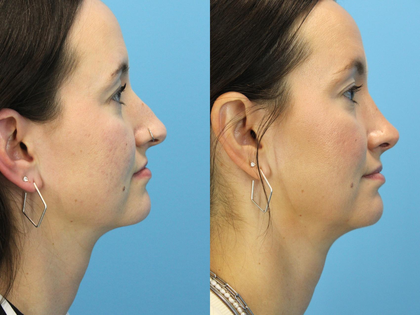 Before & After Rhinoplasty Case 567 Right Side View in West Des Moines & Ames, IA