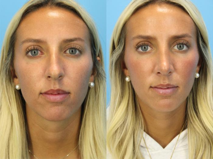 Before & After Rhinoplasty Case 575 Front View in West Des Moines & Ames, IA