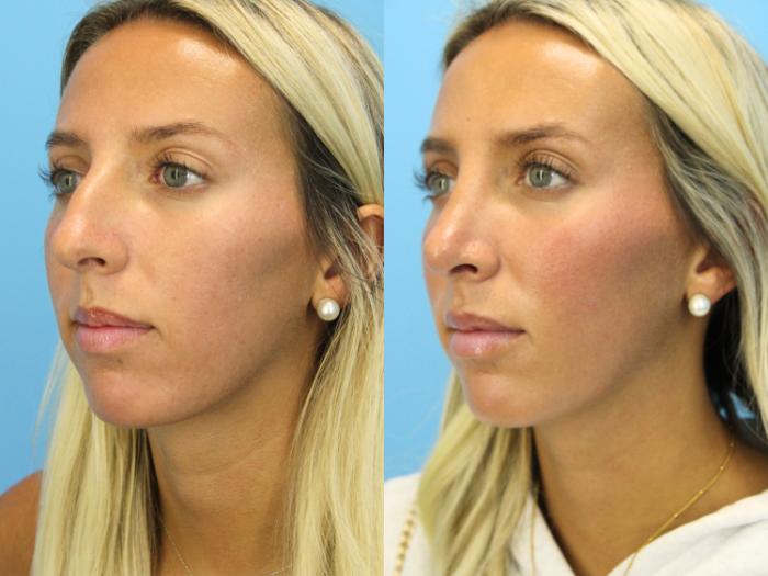 Before & After Rhinoplasty Case 575 Left Oblique View in West Des Moines & Ames, IA