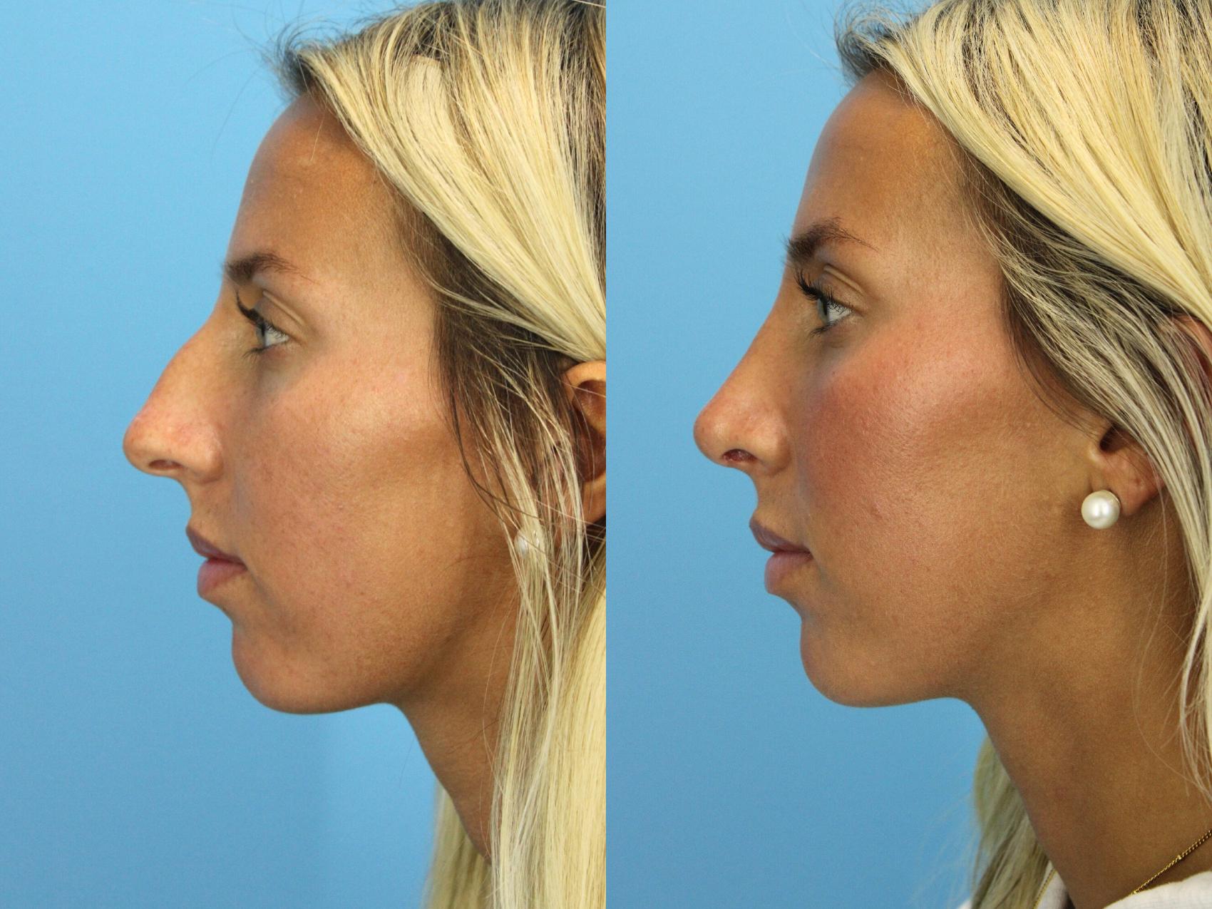 Before & After Rhinoplasty Case 575 Left Side View in West Des Moines & Ames, IA