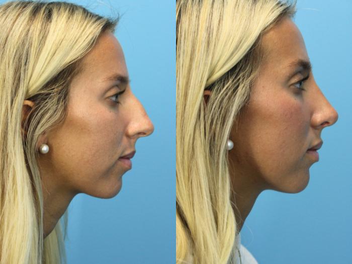 Before & After Rhinoplasty Case 575 Right Side View in West Des Moines & Ames, IA