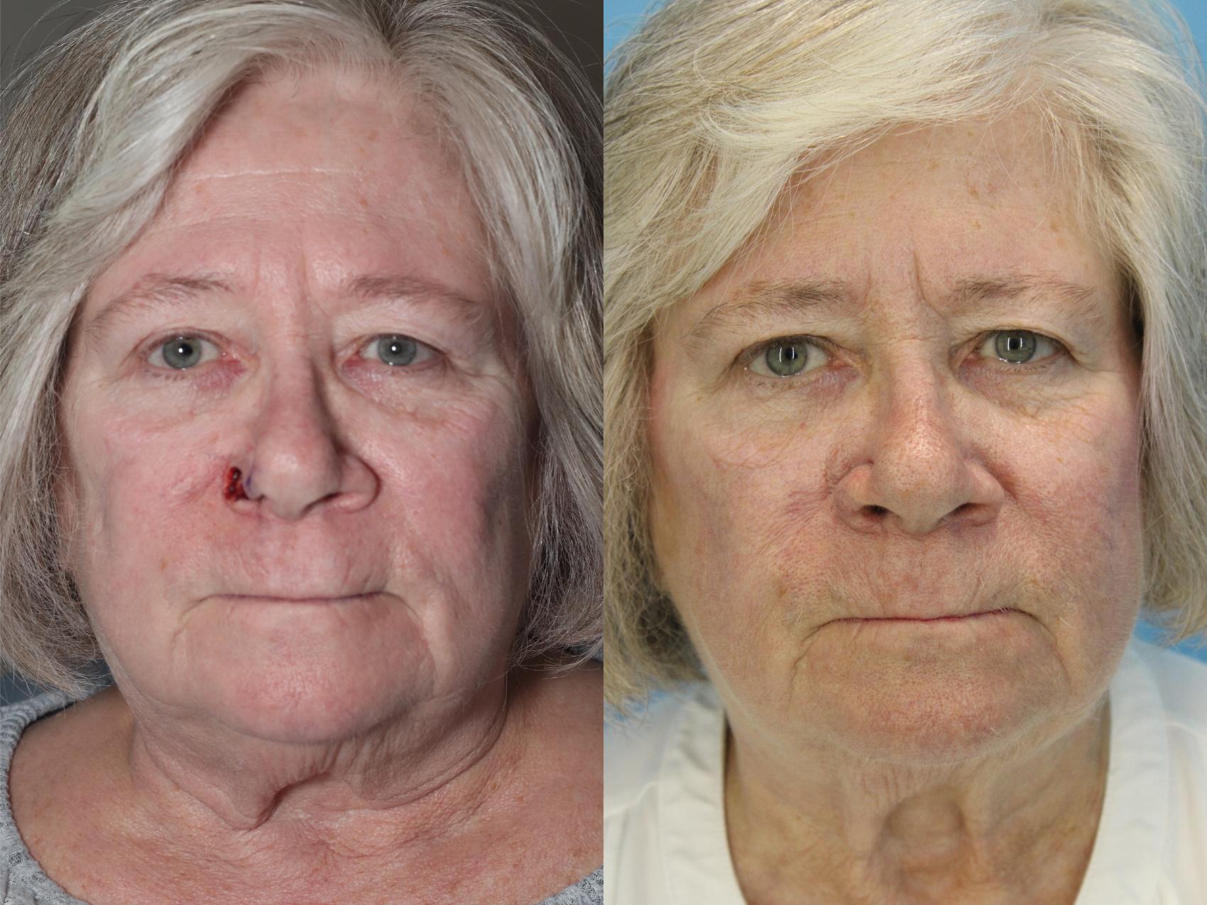Before & After Skin Cancer Repair Case 565 Front View in West Des Moines & Ames, IA