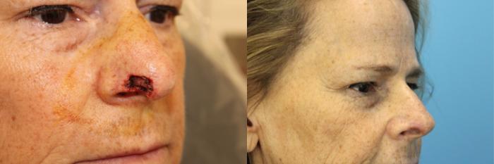 Before & After Skin Cancer Repair Case 577 Front View in West Des Moines & Ames, IA