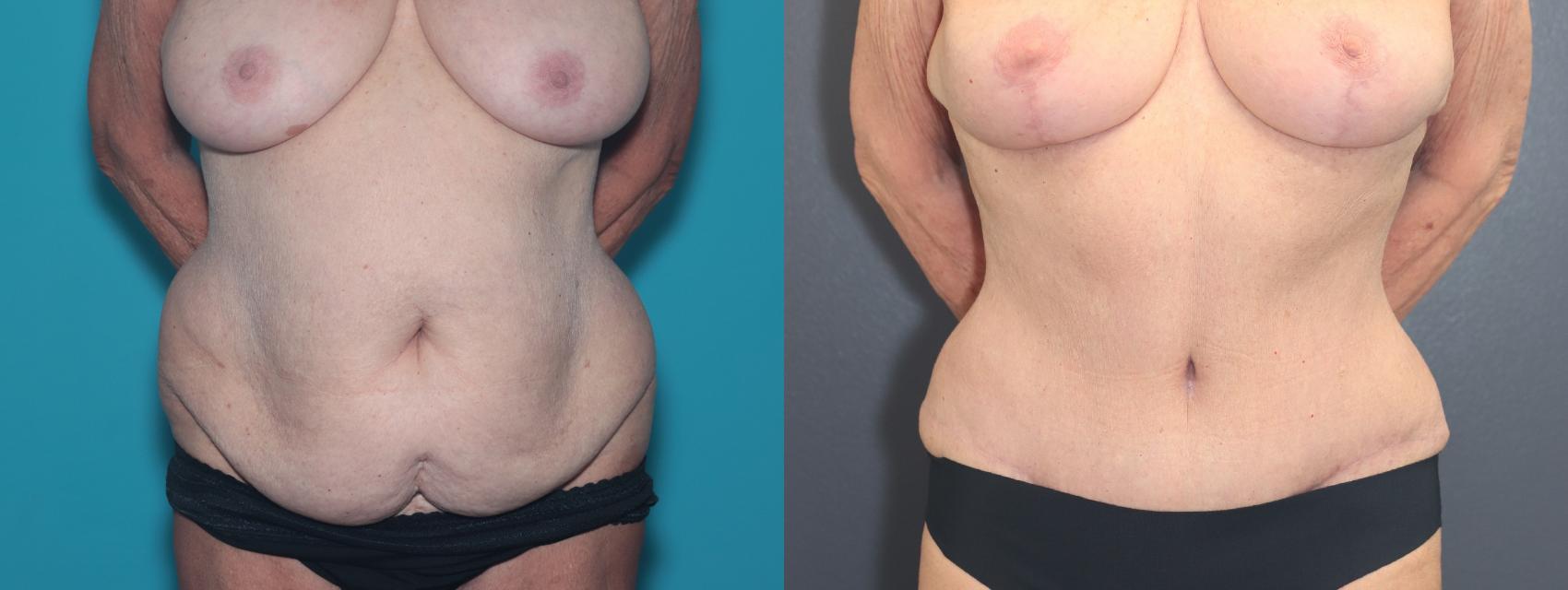 Before & After Tummy Tuck Case 526 Front View in West Des Moines & Ames, IA