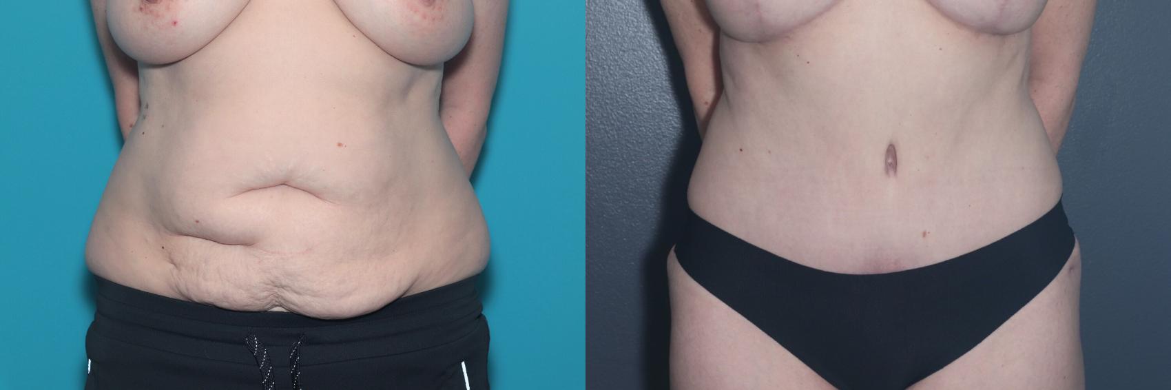 Before & After Tummy Tuck Case 531 Front View in West Des Moines & Ames, IA