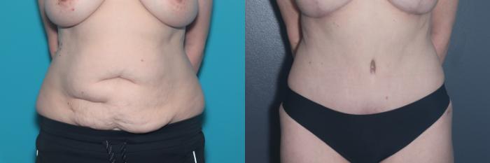 Before & After Tummy Tuck Case 531 Front View in West Des Moines & Ames, IA