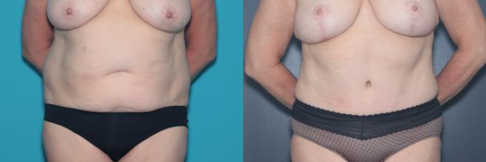 Before & After Tummy Tuck Case 536 Front View in West Des Moines & Ames, IA