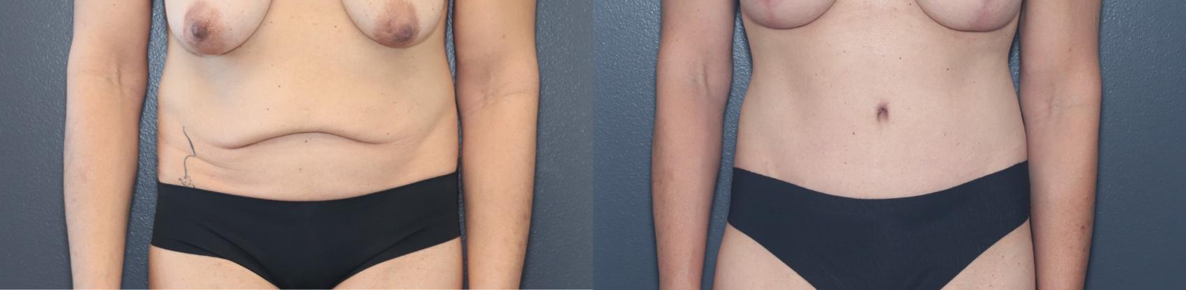 Before & After Tummy Tuck Case 541 Front View in West Des Moines & Ames, IA