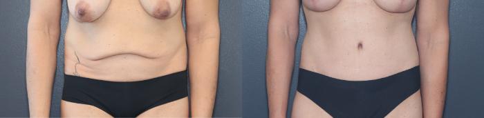 Before & After Tummy Tuck Case 541 Front View in West Des Moines & Ames, IA