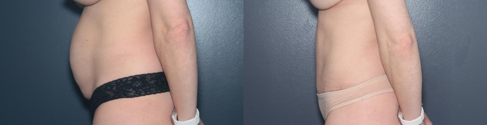 Before & After Tummy Tuck Case 573 Left Side View in West Des Moines & Ames, IA