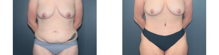 Before & After Tummy Tuck Case 648 Front View in West Des Moines & Ames, IA
