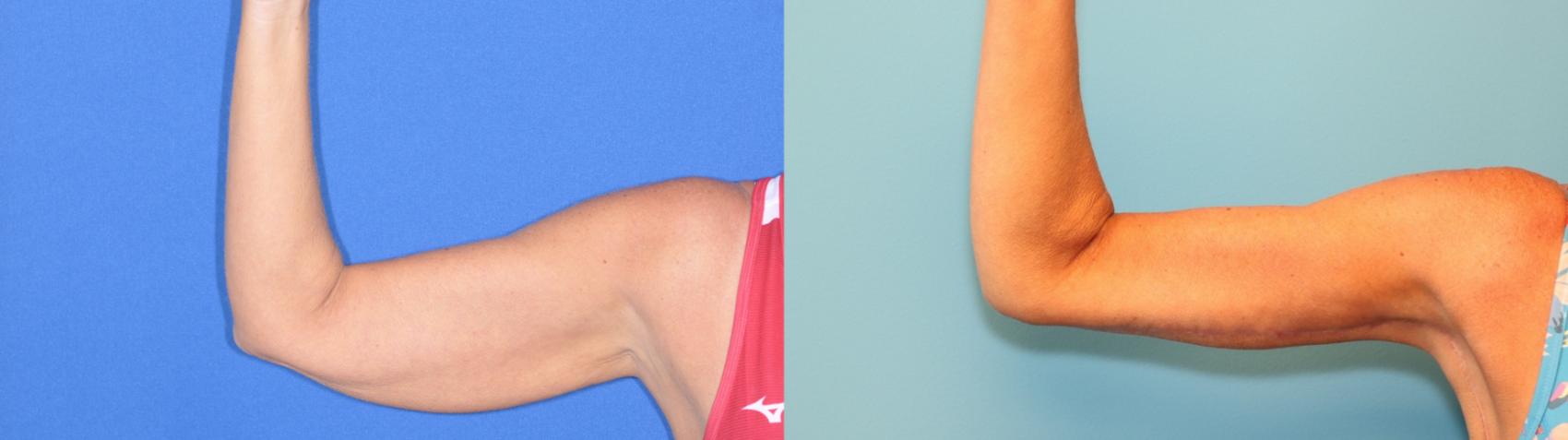 Before & After Arm Lift Case 198 Front View in West Des Moines, IA
