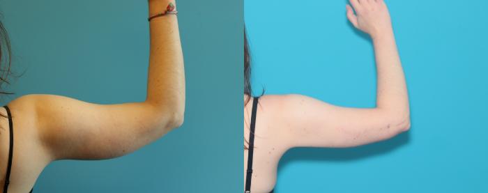 Before & After Arm Lift Case 292 Back right View in West Des Moines & Ames, IA
