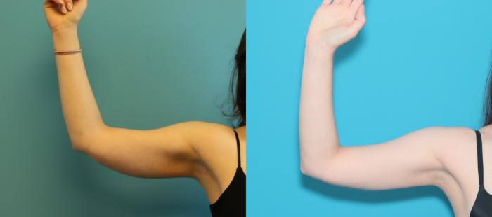 Before & After Arm Lift Case 292 Front right View in West Des Moines & Ames, IA