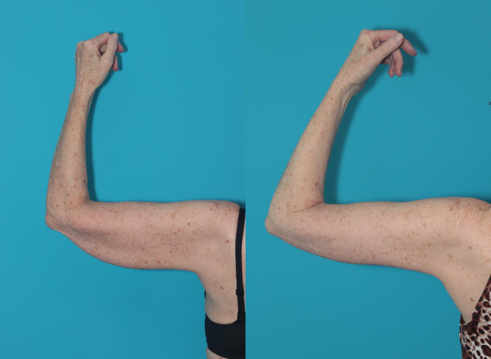 Arm Lift Before and After Pictures Case 324 West Des Moines & Ames