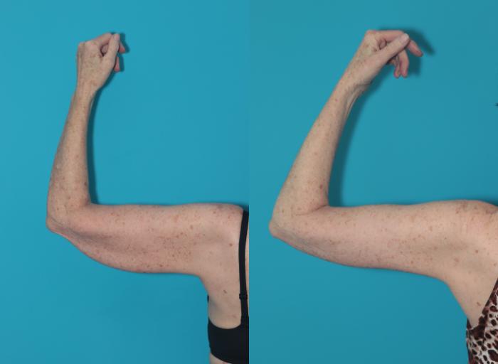 Before & After Arm Lift Case 324 Back View in West Des Moines & Ames, IA