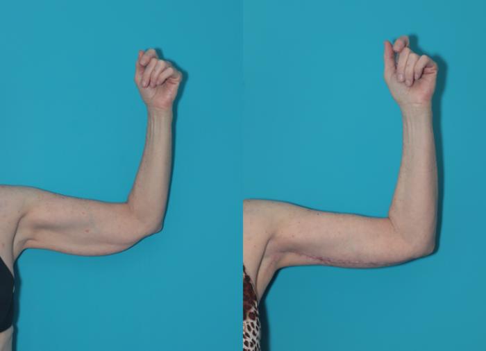 Before & After Arm Lift Case 324 Left Side View in West Des Moines & Ames, IA