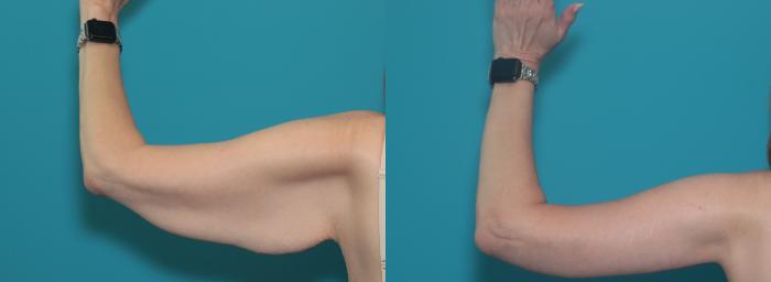 Before & After Arm Lift Case 461 Back View in West Des Moines & Ames, IA