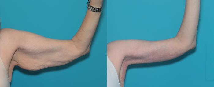 Before & After Arm Lift Case 461 Front View in West Des Moines & Ames, IA