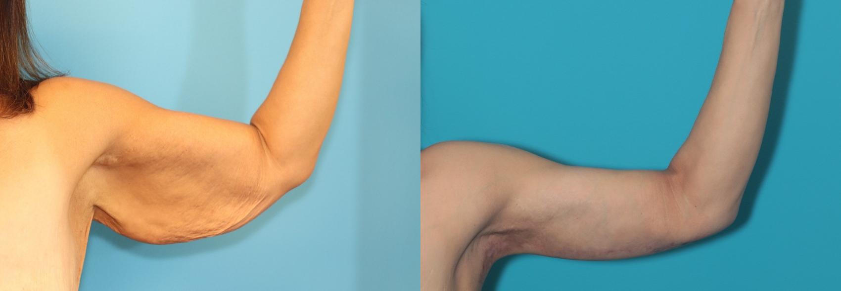 Before & After Arm Lift Case 462 Left Side View in West Des Moines & Ames, IA