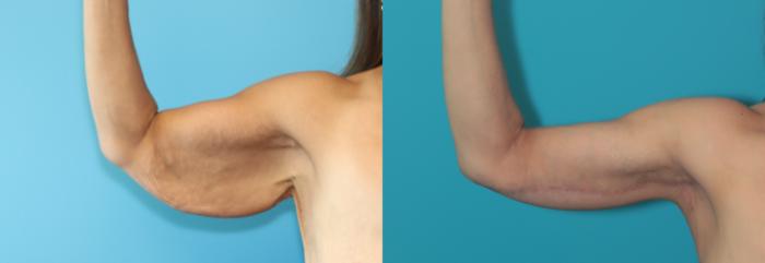 Before & After Arm Lift Case 462 Right Side View in West Des Moines & Ames, IA