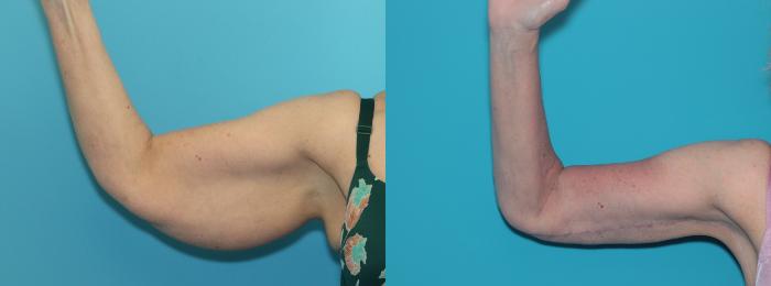 Before & After Arm Lift Case 470 Front View in West Des Moines & Ames, IA