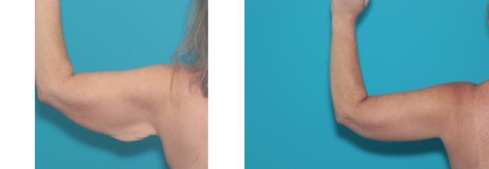 Before & After Arm Lift Case 489 Back View in West Des Moines & Ames, IA