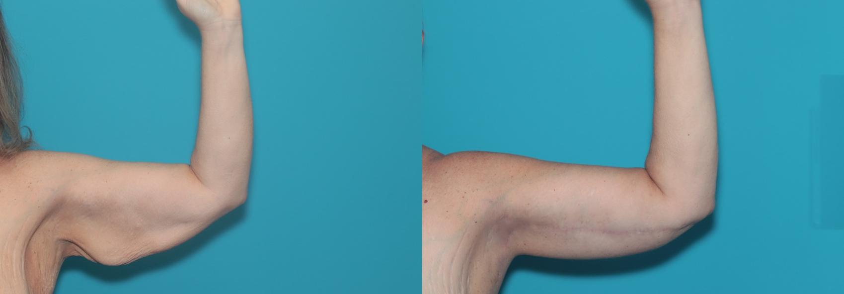 Before & After Arm Lift Case 489 Left Side View in West Des Moines & Ames, IA