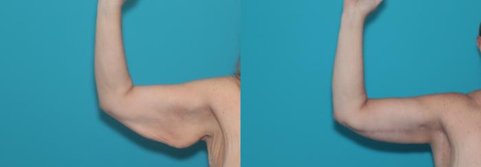 Before & After Arm Lift Case 489 Right Side View in West Des Moines & Ames, IA