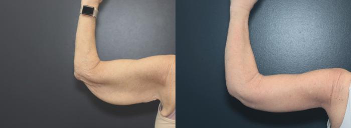 Before & After Arm Lift Case 623 Back of Left Arm  View in West Des Moines & Ames, IA