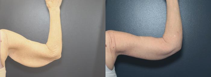 Before & After Arm Lift Case 623 Back of Right Arm View in West Des Moines & Ames, IA