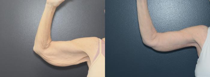 Before & After Arm Lift Case 623 Left Side View in West Des Moines & Ames, IA