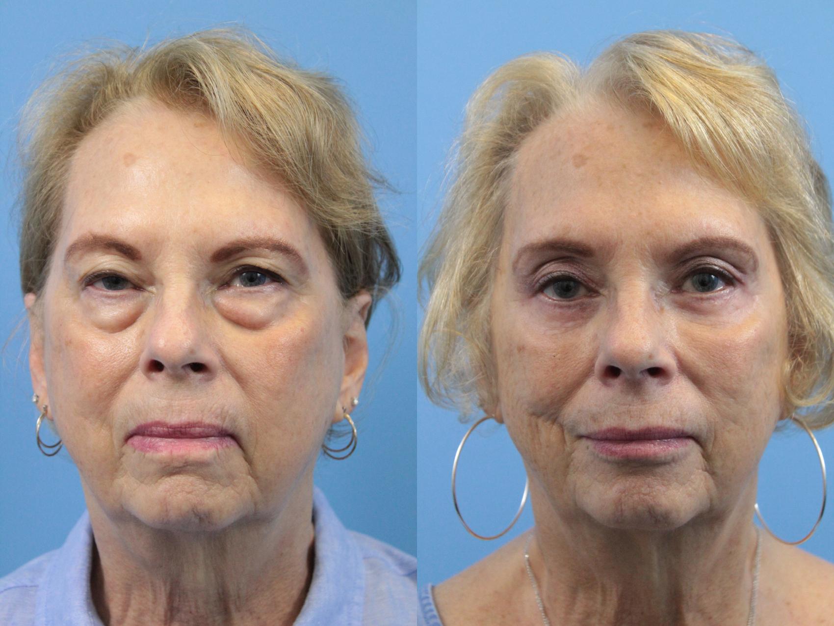 Before & After Blepharoplasty (Lower, Under Eyes) Case 149 View #1 View in West Des Moines & Ames, IA