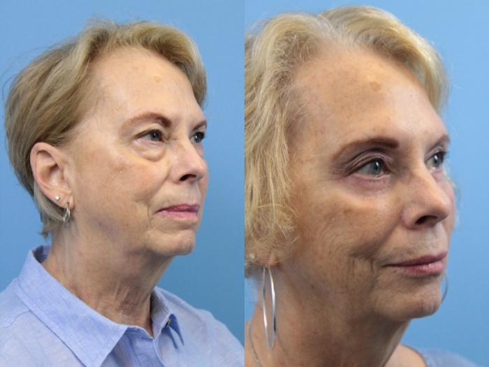 Before & After Blepharoplasty (Lower, Under Eyes) Case 149 View #2 View in West Des Moines & Ames, IA
