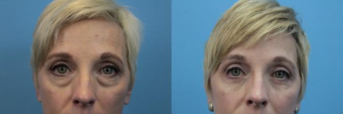 Before & After Blepharoplasty (Lower, Under Eyes) Case 351 Front close up View in West Des Moines & Ames, IA
