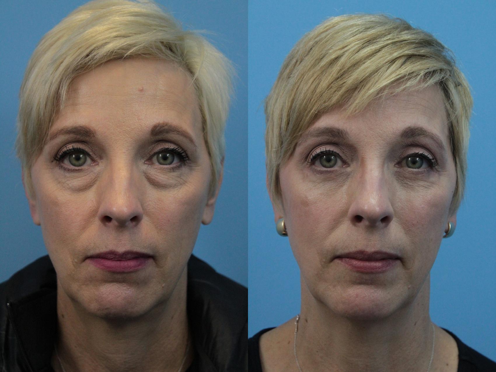 Before & After Blepharoplasty (Lower, Under Eyes) Case 351 Front View in West Des Moines & Ames, IA