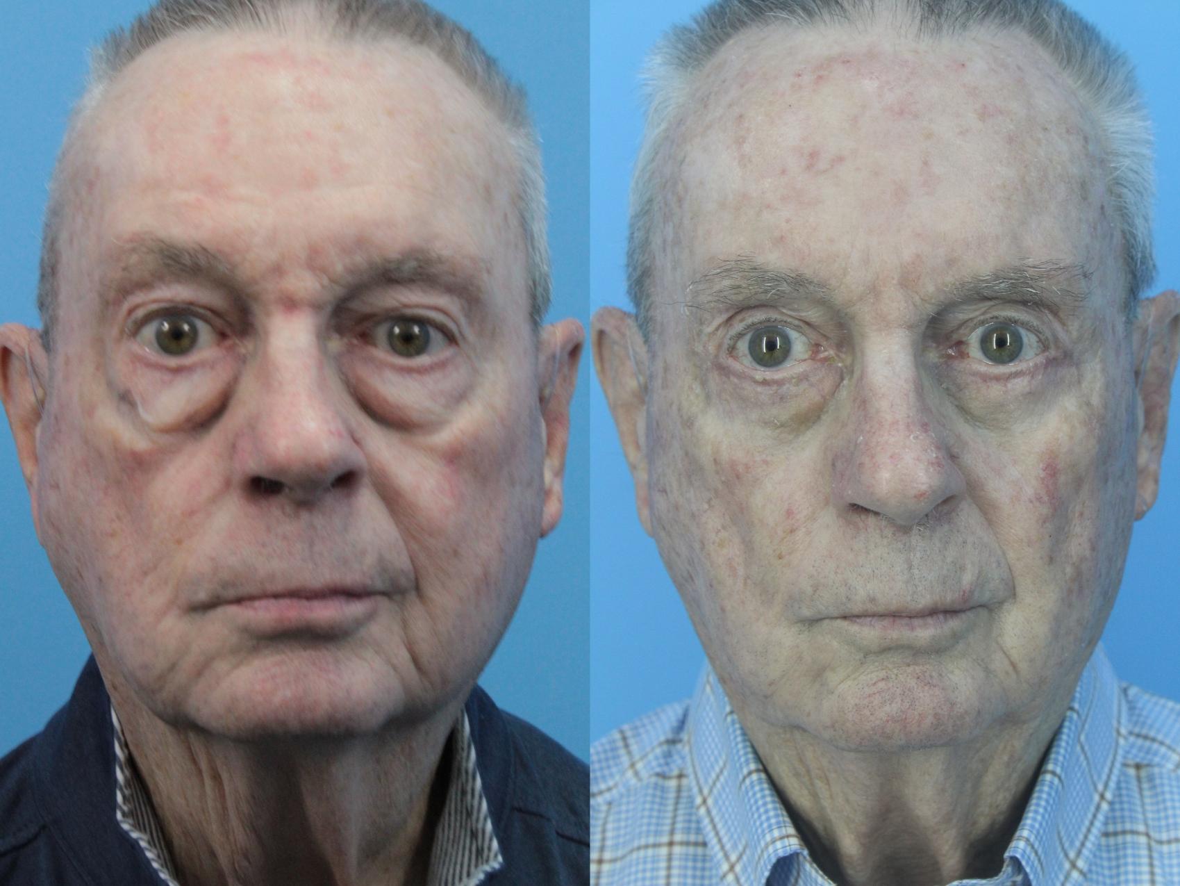 Before & After Blepharoplasty (Lower, Under Eyes) Case 428 Front View in West Des Moines & Ames, IA