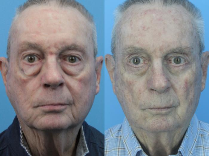 Before & After Blepharoplasty (Lower, Under Eyes) Case 428 Front View in West Des Moines & Ames, IA
