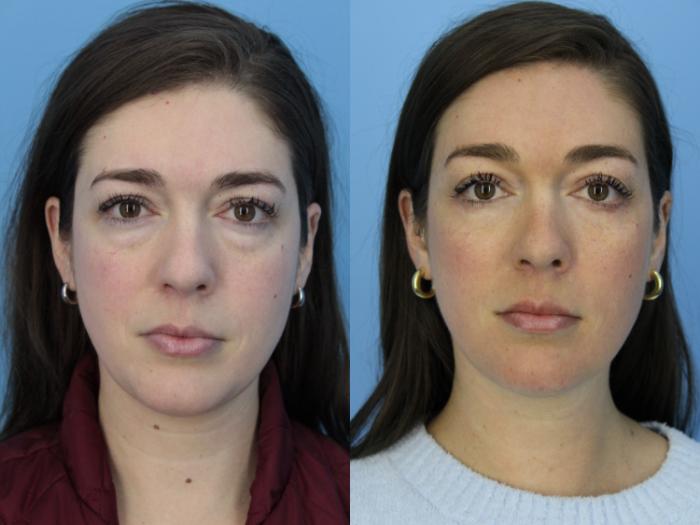 Before & After Blepharoplasty (Lower, Under Eyes) Case 439 Front View in West Des Moines & Ames, IA