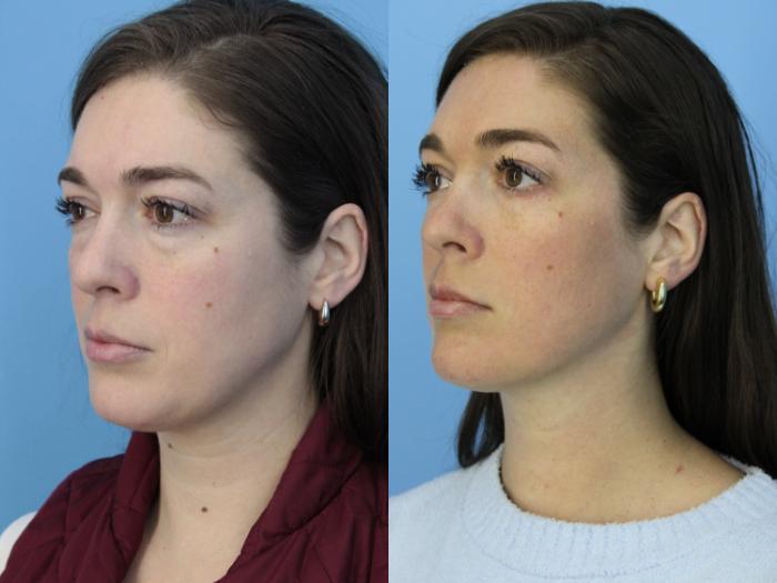 Before & After Blepharoplasty (Lower, Under Eyes) Case 439 Left Oblique View in West Des Moines & Ames, IA