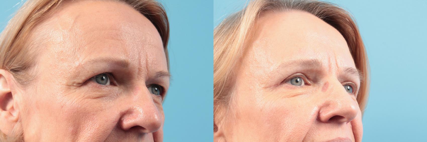 Before & After Blepharoplasty (Upper Eyelid Lift) Case 101 View #1 View in West Des Moines & Ames, IA