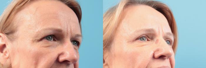 Before & After Blepharoplasty (Upper Eyelid Lift) Case 101 View #1 View in West Des Moines & Ames, IA