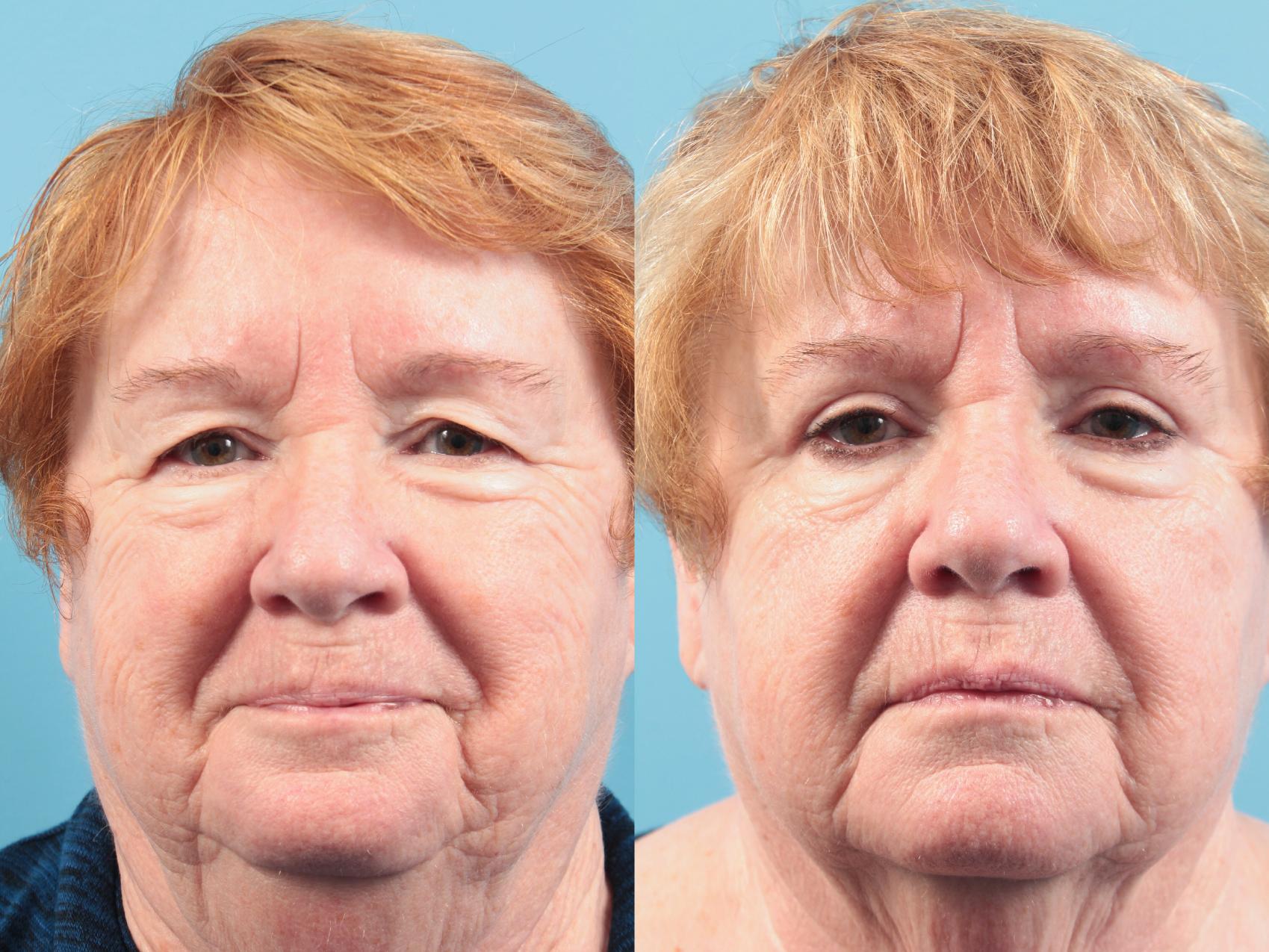 Before & After Blepharoplasty (Upper Eyelid Lift) Case 107 Front View in West Des Moines & Ames, IA