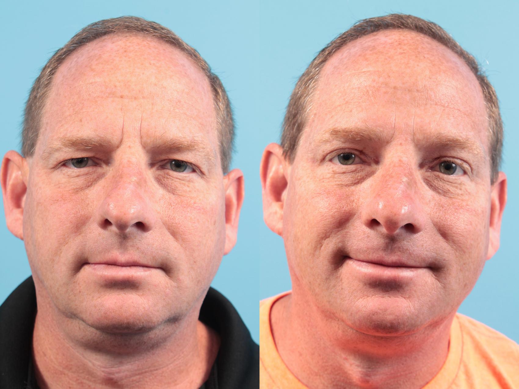Before & After Blepharoplasty (Upper Eyelid Lift) Case 112 View #1 View in West Des Moines & Ames, IA