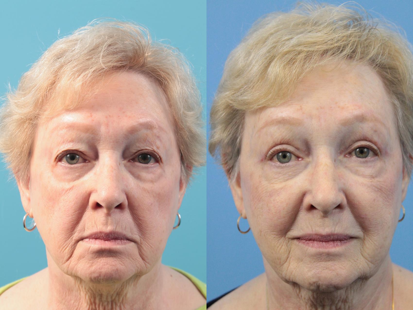 Before & After Blepharoplasty (Upper Eyelid Lift) Case 115 Front View in West Des Moines & Ames, IA