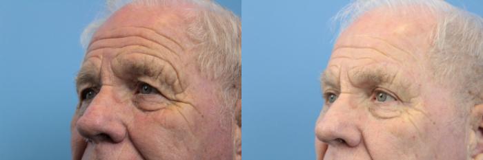 Before & After Blepharoplasty (Upper Eyelid Lift) Case 123 View #2 View in West Des Moines & Ames, IA