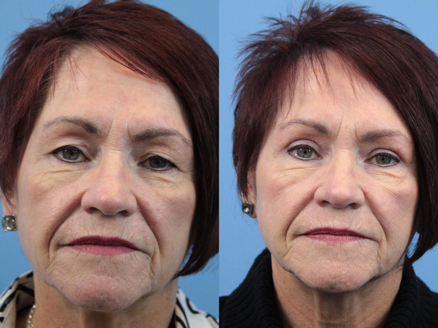 Before & After Blepharoplasty (Upper Eyelid Lift) Case 131 Front View in West Des Moines & Ames, IA