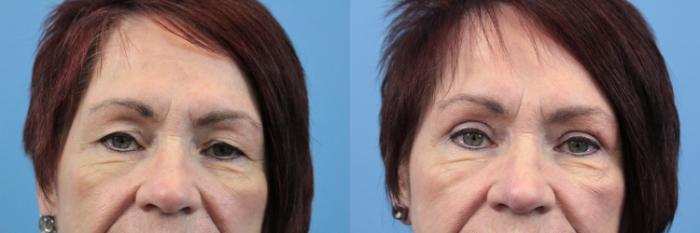 Before & After Blepharoplasty (Upper Eyelid Lift) Case 131 View #2 View in West Des Moines & Ames, IA