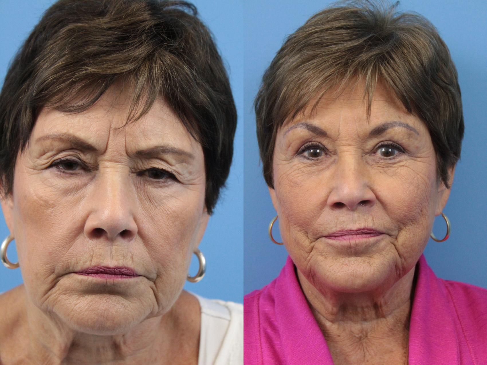 Before & After Blepharoplasty (Upper Eyelid Lift) Case 139 View #1 View in West Des Moines & Ames, IA