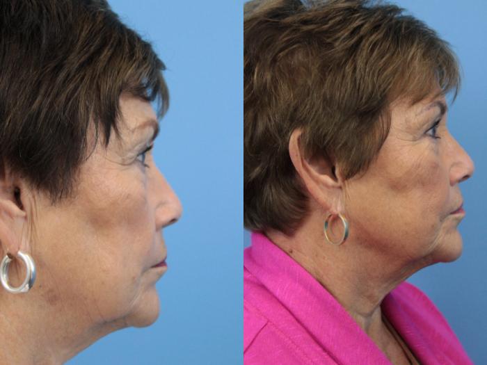 Before & After Blepharoplasty (Upper Eyelid Lift) Case 139 View #2 View in West Des Moines & Ames, IA